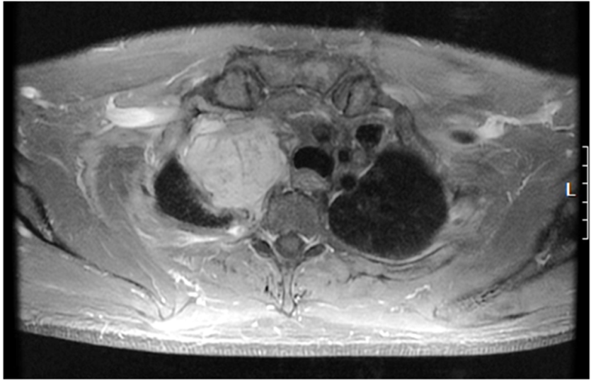 Figure 3 MRI Scan Of The Tumor Transverse View Of T1 Weighted Fat Saturated Images With