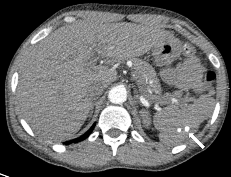 Figure 2. Axial CT with contrast demonstrates calcified granulomas in