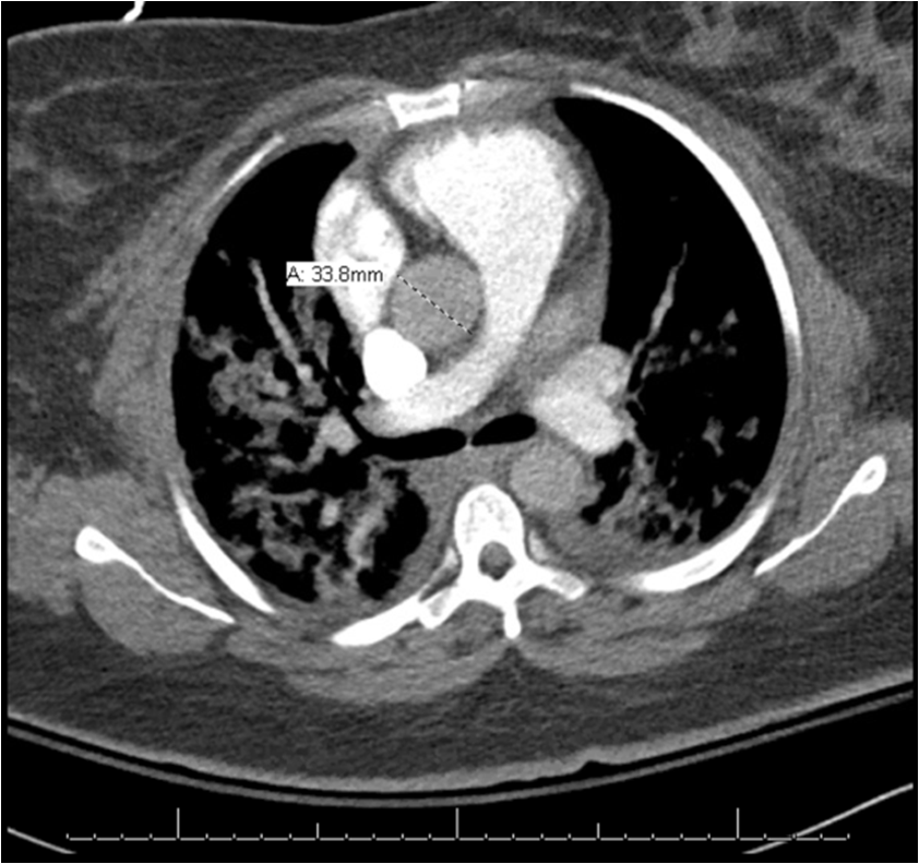 Figure 2. CT Angiography Chest Reveals Cardiomegaly With Pulmonary ...