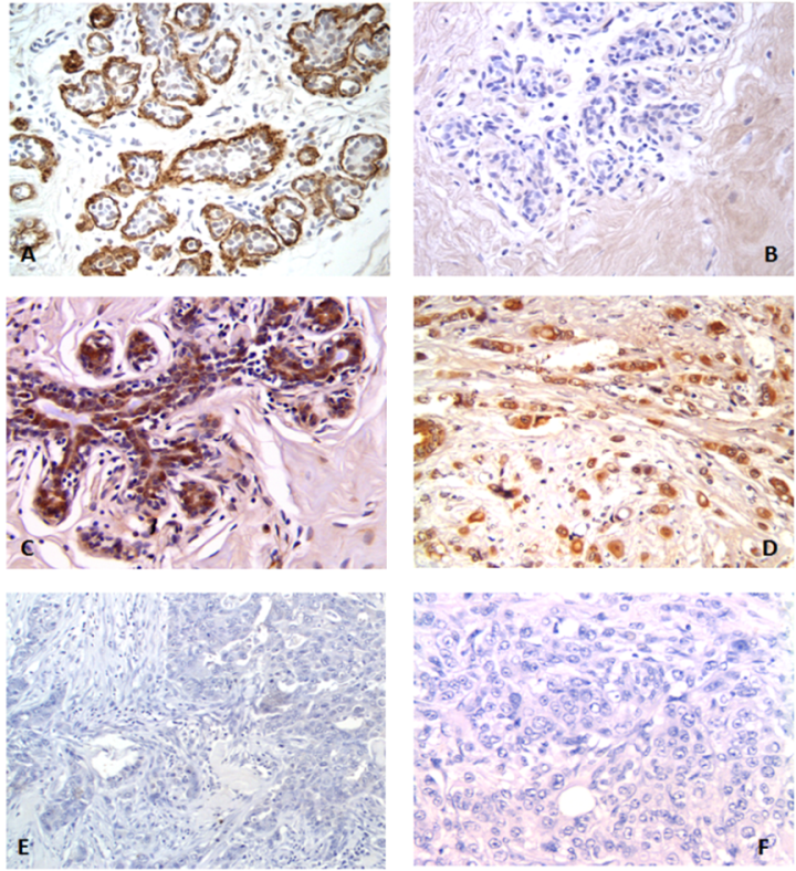 Figure 5. IHC staining of breast tissues using BC-24 anti-TNC antibody ...