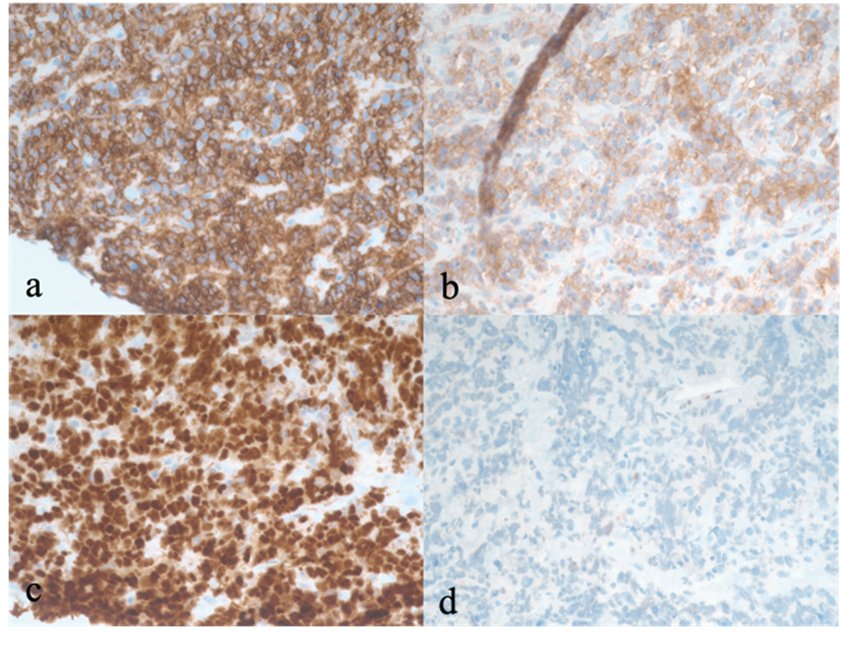 Figure 3. Immunohistochemical staining of the patient’s biopsy ...