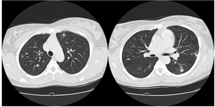 Figure 1. Chest CT scan in lung window. Axial cut revealing bilateral ...