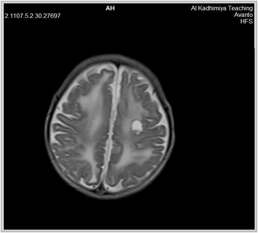 Figure 8. A 3 months old male patient, T2 weighted axial section shows ...